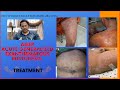 AGEP / Acute generalized exanthematous pustulosis | Sudden pus filled rashes on skin / Drug Rash