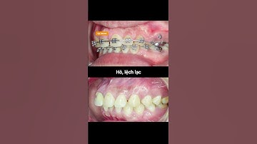 Cận cảnh quá trình niềng răng hô, lệch lạc