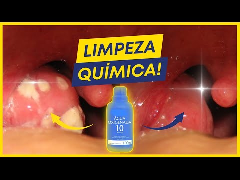 COMO REMOVER CÁSEOS COM LIMPEZA QUÍMICA DAS AMÍGDALAS?