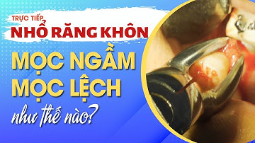 Quy Trình Nhổ Răng Khôn Mọc Ngầm