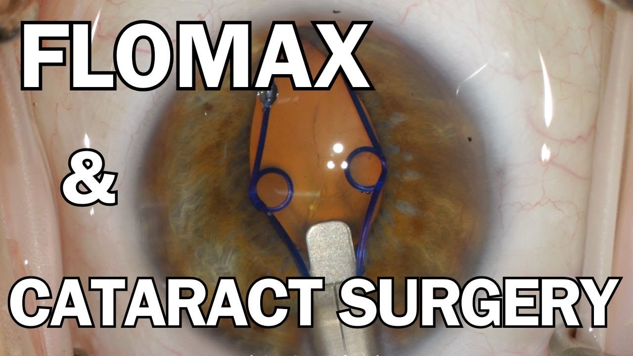 FLOMAX & Cataract Surgery | My Approach