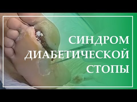 Синдром диабетической стопы. Биологическая медицина в лечении некробиотических трофических язв