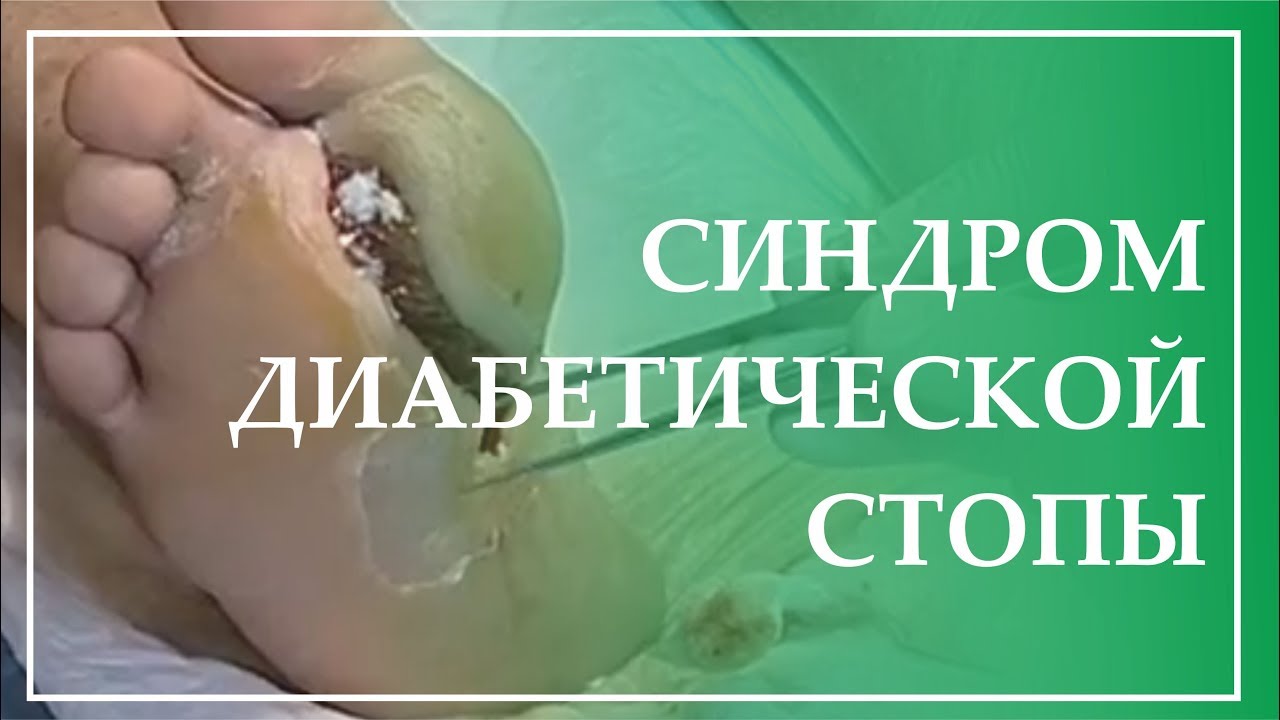 Синдром диабетической стопы Синдром диабетической стопы