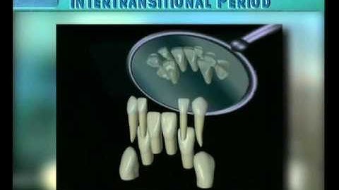 Clip 8: Transition of Mandibular Incisors with Moderate Space