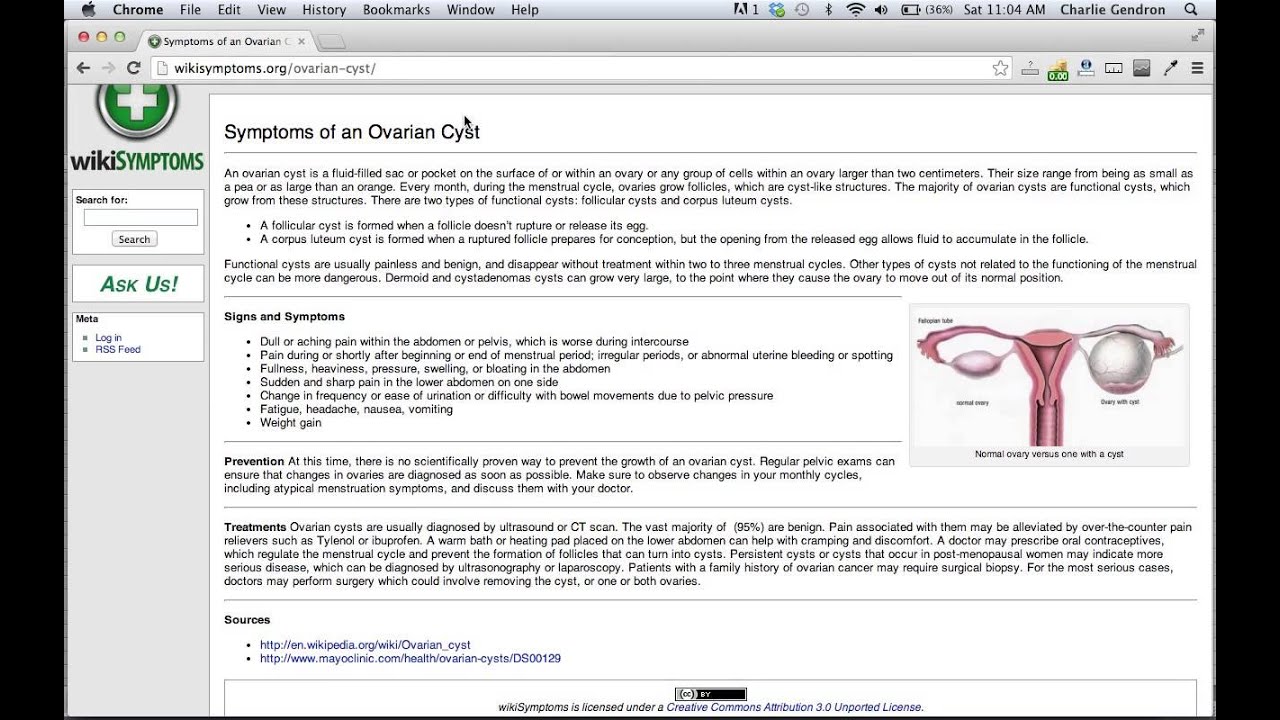 Ovairan Cyst Prevention | wikiSymptoms