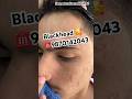 Blackhead ✅🥰#trending #treatment #blackhead #shortsfeed #srsalon #shorts #viral #viralvideo