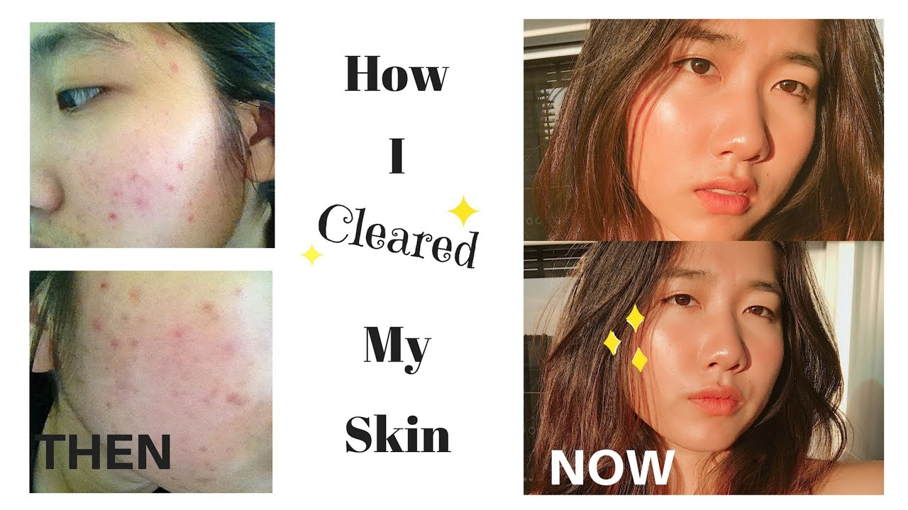 How I clear my skin l ทำยังให้สิวหาย YouTube