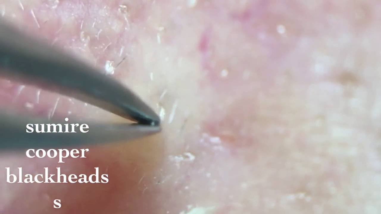 鼻角栓84.2nose blackheads（Larger version）★Tweezers only★ YouTube