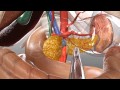 Pancreatic Tail Resection