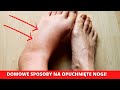 Opuchnite nogi i stopy  domowe sposoby  skuteczne i sprawdzone