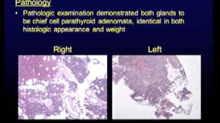 Debate 2 - Focused parathyroidectomy is preferred