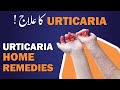 Top 3 Natural Remedies To Get RID Of URTICARIA Skin Allergy Chapaki Ka Ilaj Top 3 Natural Remedies To Get RID Of URTICARIA Skin Allergy Chapaki Ka Ilaj