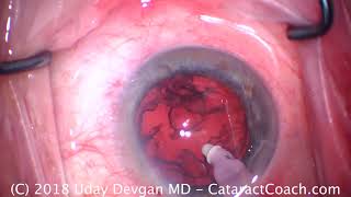 Cataract Surgery in an eye with prior LASIK