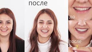 LIVE! Отбеливание зубов Philips ZOOM 4 (White Speed) в Orlovsky Dental Center Правобережье