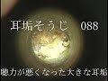 耳垢そうじ/聴力が悪くなった耳垢/088