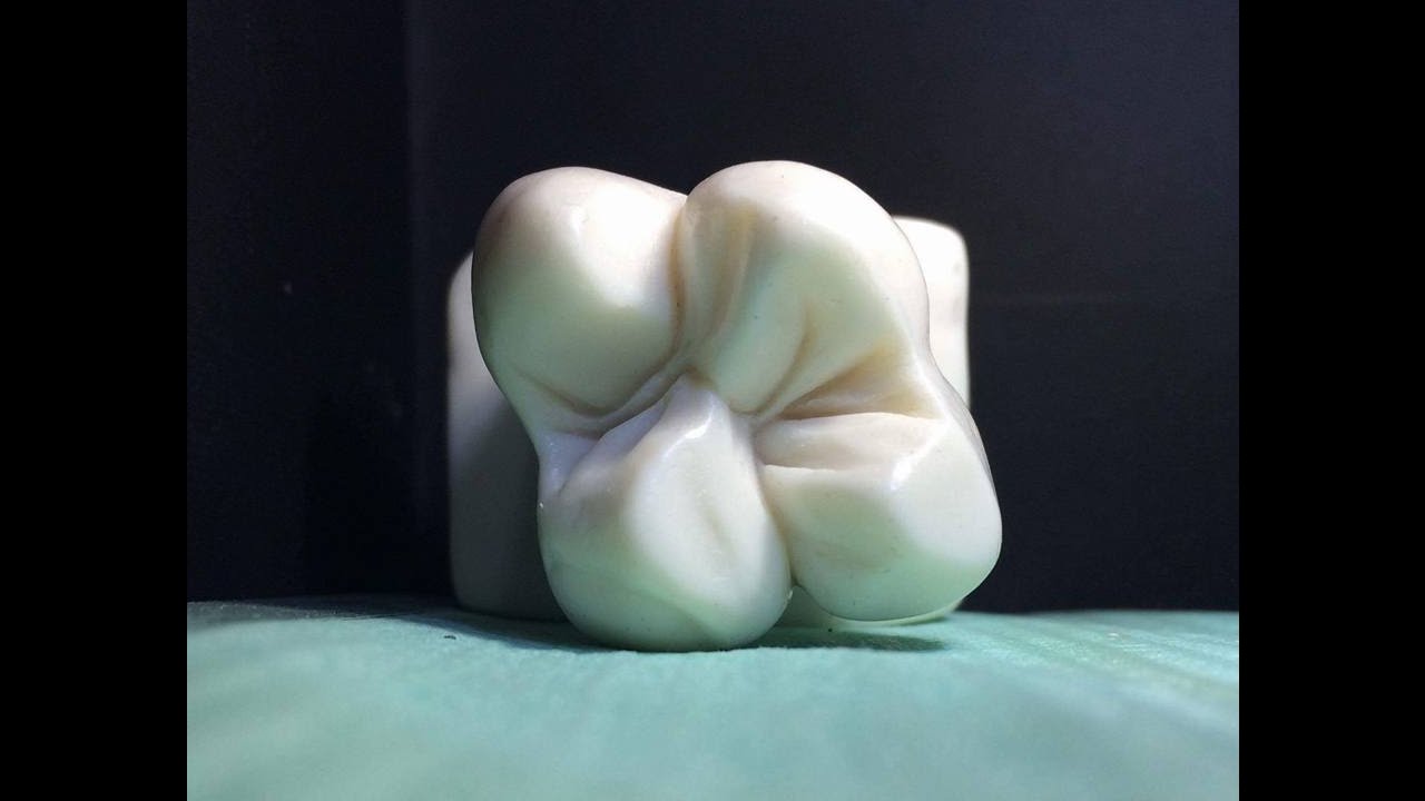 Carving occlusal surface of UPPER 6 ( MAXILLARY FIRST MOLAR )