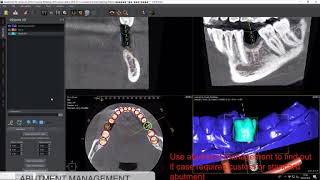 How to manage the abutment in Quickvision 3D