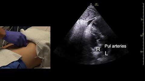 Subcostal (subxiphoid) Echocardiography Scan Techniques
