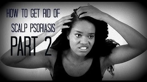 How to Get Rid of Scalp Psoriasis (Part 2)