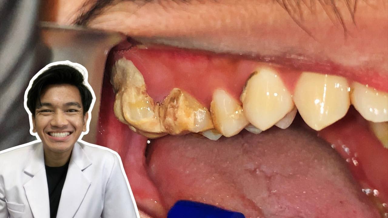 It’s very satisfying to see that the patient's teeth are clean. YouTube