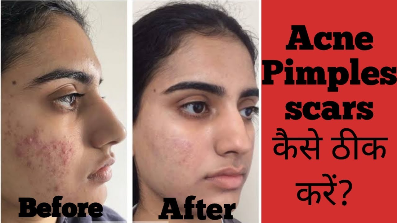 acne marks best cream | acne scars treatment | pimples scar removal on face at home | mederma cream