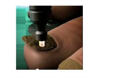Laser Toenail Treatment Aiken SC - Angela Molnar D...