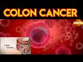    colon cancer   khulla panna desk