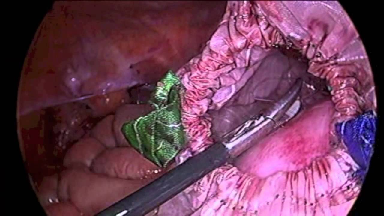 Contained ElectroMechanical Bag Morcellation YouTube