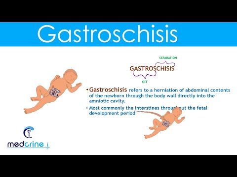 Video: Gastroschisis: Photo, Reasons, Consequences