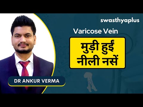 वेरिकोज़ वेन्स: कारण और लक्षण | Varicose Veins in Hindi | Signs & Treatments | Dr Ankur Verma