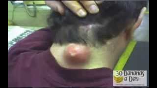BIGGEST ZIT ON PLANET EARTH!!! warning! MOST disgusting version! #2