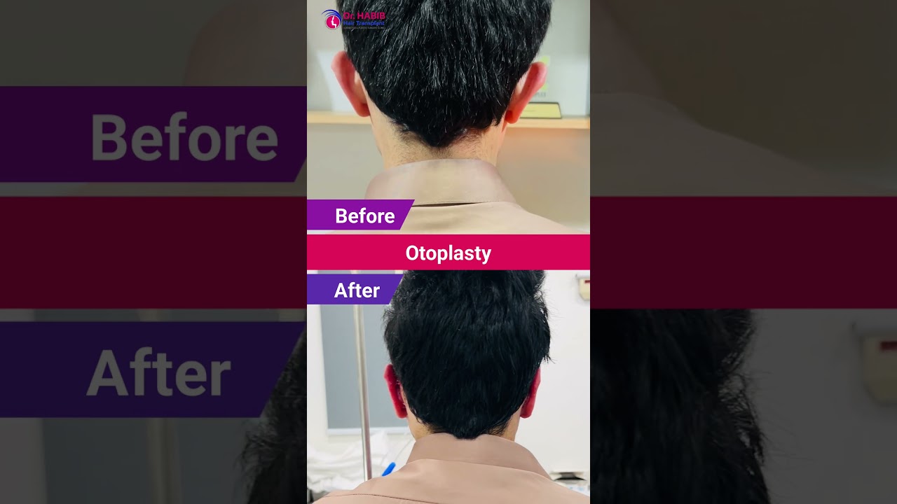 👂 Otoplasty Transformation! Dr. Habib's Expertise Unveiled 😲 | Peshawar Clinic