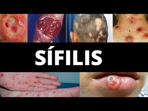 SÍFILIS: Causa, Transmissão, Sintomas, Fases, Diagnóstico, Tratamento, Prevenção