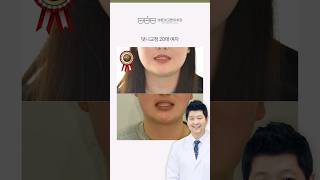 [바른이고른이치과] ⭐덧니교정 20대 여자⭐  #덧니교정 #반대교합