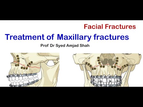 Treatment of Maxillary Fractures | Le Fort | ORIF | Syed Amjad Shah