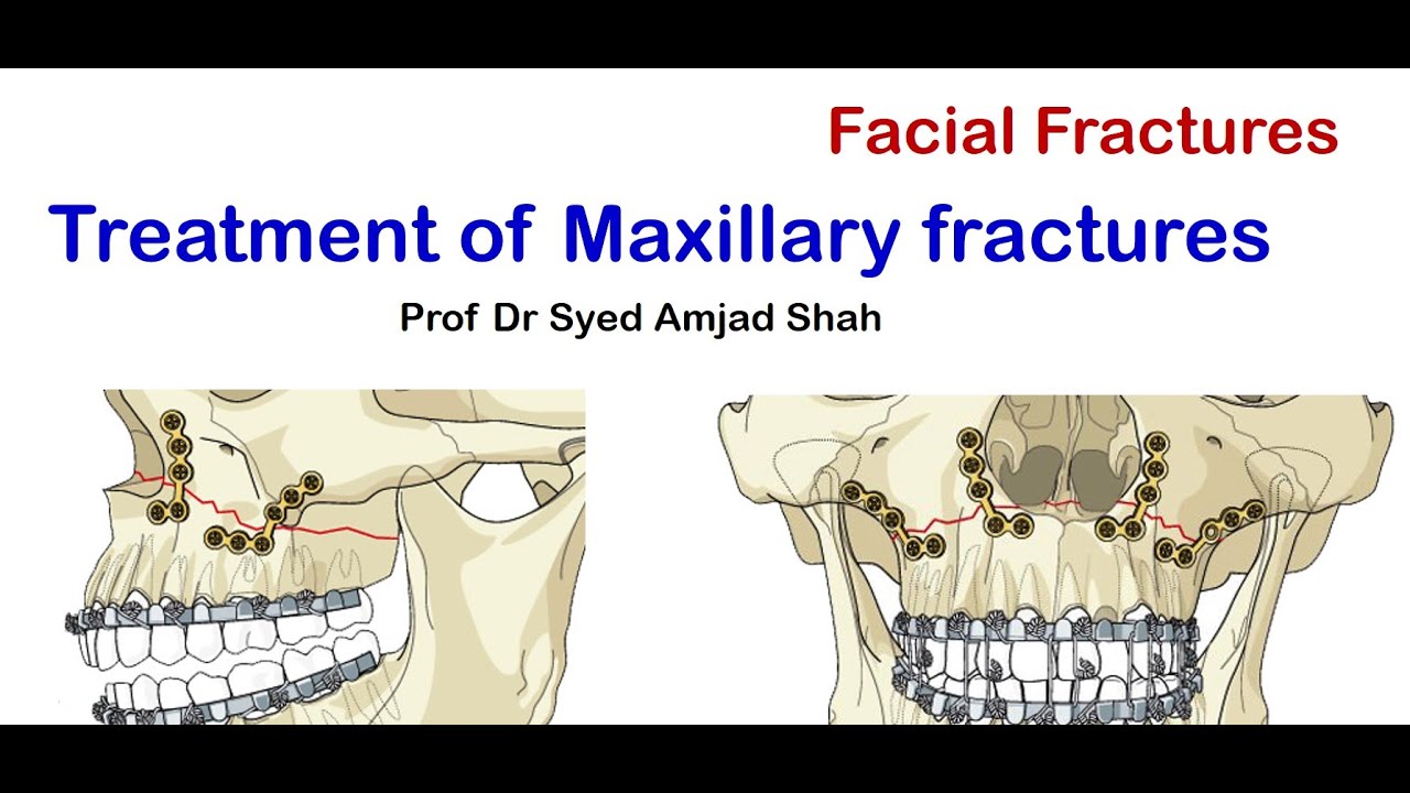 Maxillary Fracture