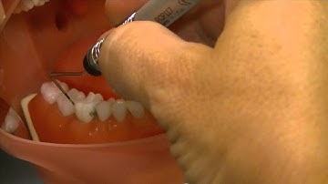 Probe Buccal of 4th Quadrant