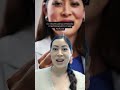 How To Treat Corneal Scarring Eye Doctor Explains 