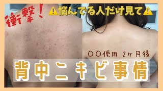 【背中ニキビ】自宅で簡単