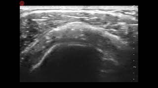 Platelet Rich Plasma for Shoulder Bursitis or Impingement.  Do You have shoulder pain? screenshot 3