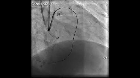 Aortic dissection and radial rupture during retrograde CTO PCI: Management of complications VİDEO 5