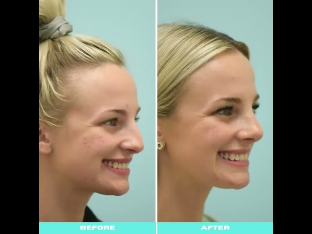 Dallas Cosmetic Surgery | Rhinoplasty | Patient Testimonial