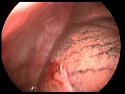 Thoracoscopic pleural catheter placement - YouTube