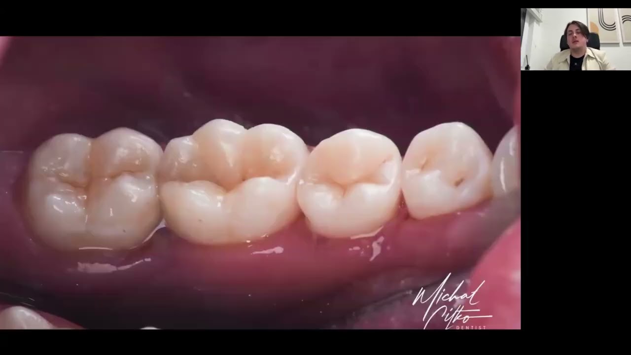 🦷 Druga klasa bez tajemnic – jak robi to Michał Citko? | Idealne wypełnienia krok po kroku