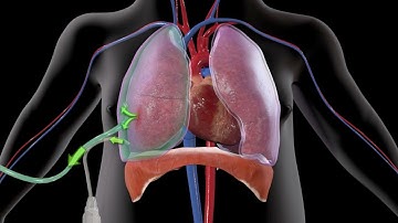 How Easy Treatment of Pneumothorax Could Have Been