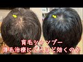【男女】薄毛治療にオススメの育毛シャンプーはこれです。