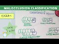 malocclusion of teeth I orthodontics lecture