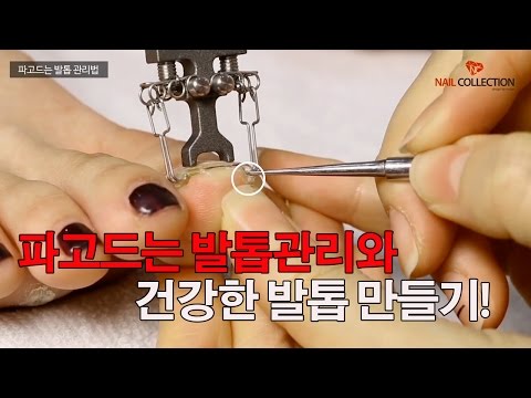 파고드는 발톱과 손상된 발톱을 관리하는 올바른 방법! 더이상 고통은 참자마세요! _Nailcollection by midae