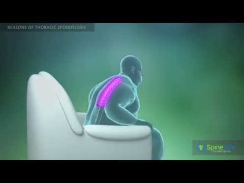 Video: Thoracic Spondylosis: Latihan, Gejala, Penyebab, Perawatan