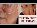 &ldquo;ADHESIVE FOR MELASMA&rdquo; ADHESIVE TO REMOVE SPOTS AND MELASMA (MAGNESIUM ADHESIVE)